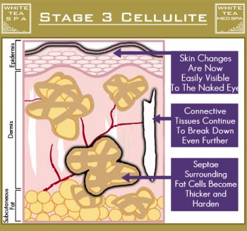 เซลลูไลท์ cellulite stage 3