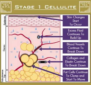 เซลลูไลท์ cellulite stage 1