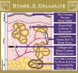 เซลลูไลท์ cellulite stage 2